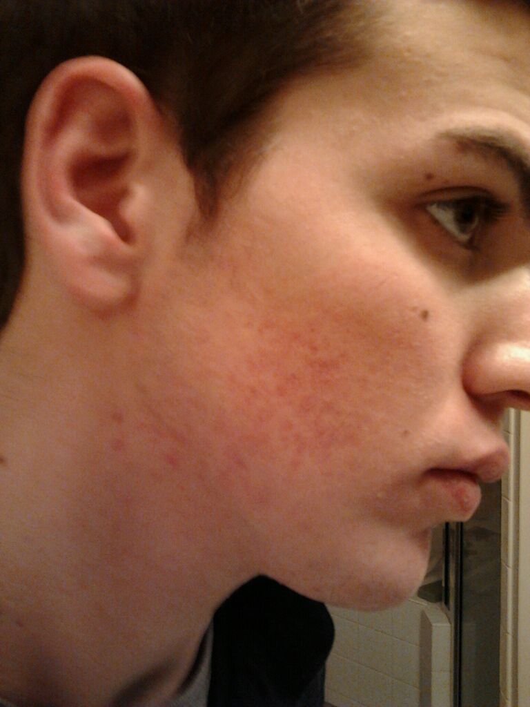accutane 10mg twice a week accutane 10mg twice a week